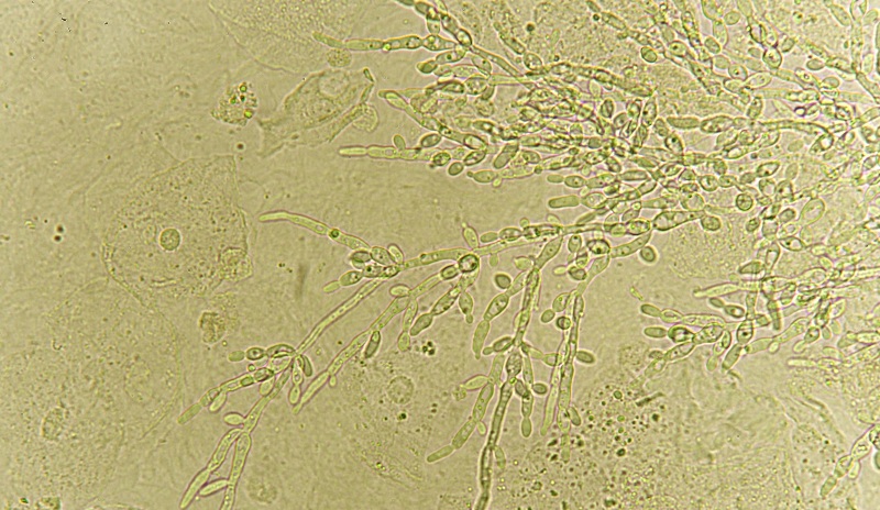 todos los meses tengo candidiasis: diagnóstico