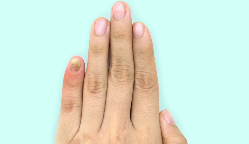 Infección por hongos en las uñas  El médico interactivo