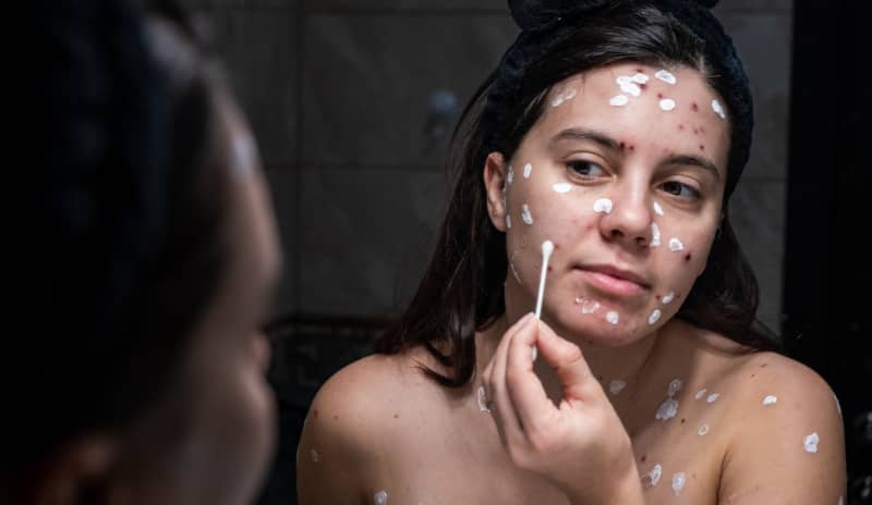 Adultos con varicela