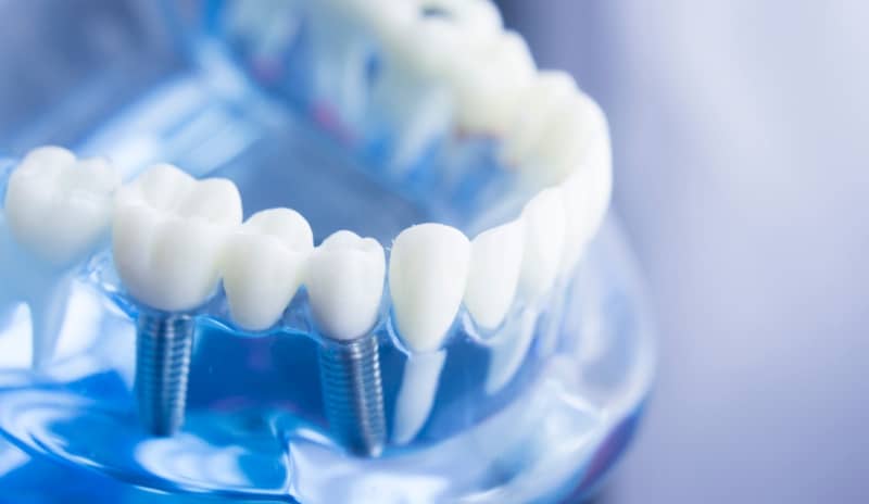 El tipo de prótesis dental que se elija dependerá de las necesidades y preferencias individuales de cada persona.