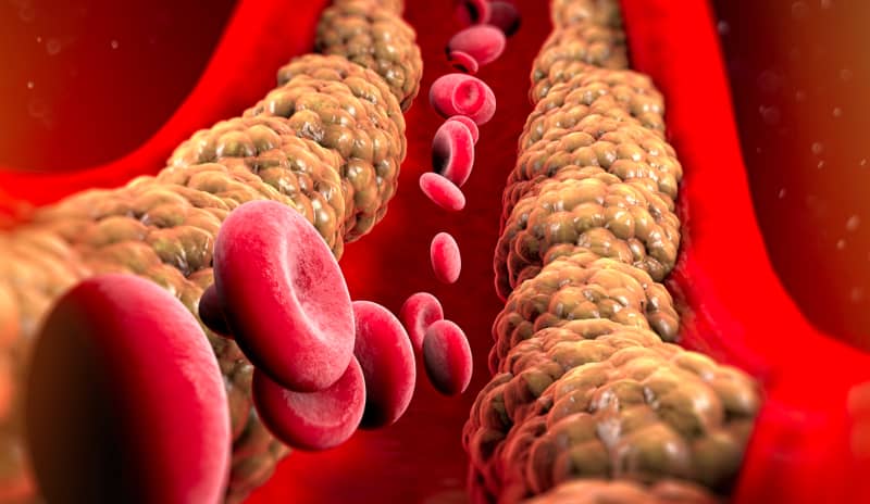 Ilustración médica de una arteria con acumulación de placas de grasa que obstruyen el paso de los glóbulos rojos, representando los efectos del colesterol elevado en el sistema cardiovascular.