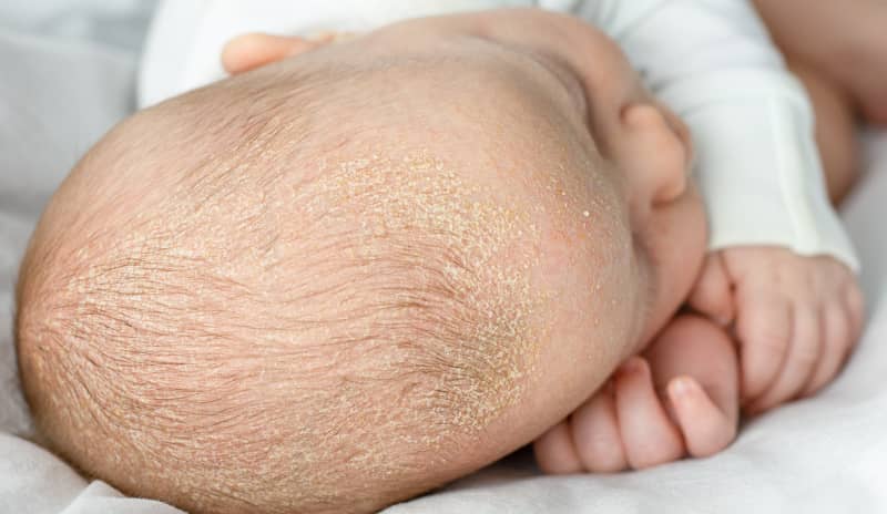 En los bebés, la dermatitis seborreica infantil suele aparecer en el cuero cabelludo, causando costras y escamas visibles que a menudo se resuelven con el tiempo.