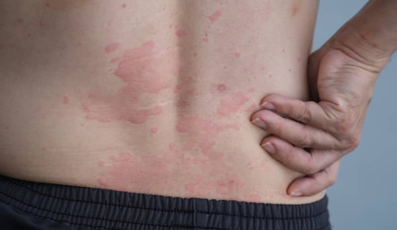 urticaria colinergica