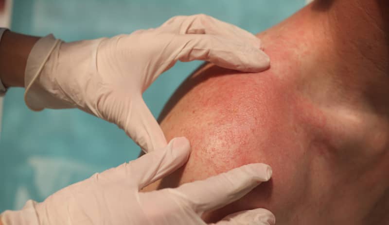 urticaria colinérgica doctor