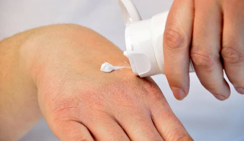 sabañones en las manos