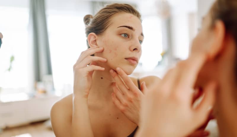 Mujer joven observando su rostro con acné frente al espejo y tocando su mejilla para analizar los distintos tipos de granos en la cara