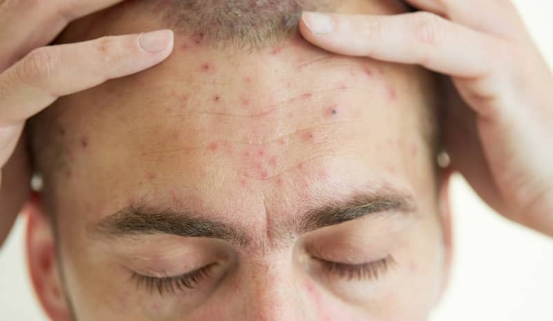 Primer plano de un hombre con granos y manchas rojas en la frente, posibles síntomas de varicela en adultos