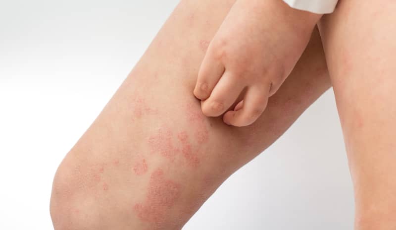 Pierna con placas y enrojecimiento por dermatitis atópica, con una mano rascando la zona afectada