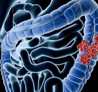 Mitos sobre el cáncer de colon