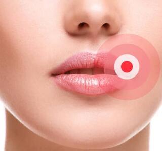 herpes-en-la-boca