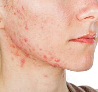acné en la cara mejilla