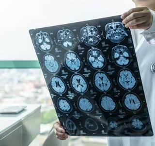 ¿Qué son los ictus?