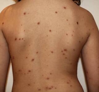 Adultos con varicela