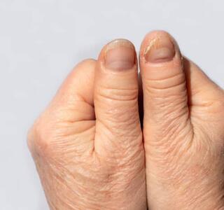 hongos en las uñas de las manos