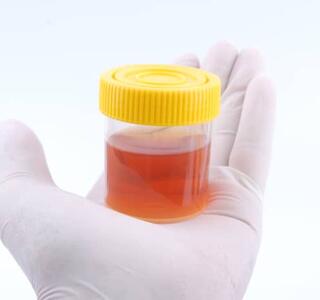 Un bote trasparente con un muestra de orina naranja, sostenida por una mano con un guante médico.