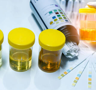 test de orina oscura