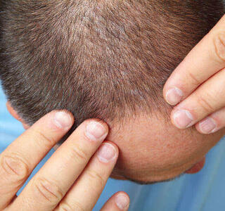 alopecia masculina