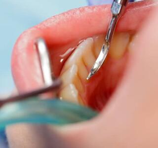 El sarro dental se forma cuando la placa bacteriana se endurece y se adhiere a los dientes.