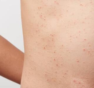 Enfermedad de Fabry: angioqueratomas