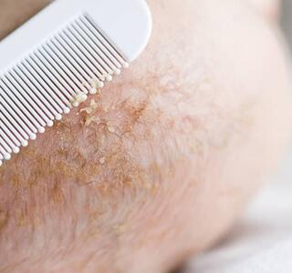 La dermatitis seborreica infantil provoca escamas en áreas grasas de la piel.
