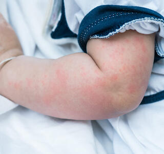 enfermedad de la bofetada