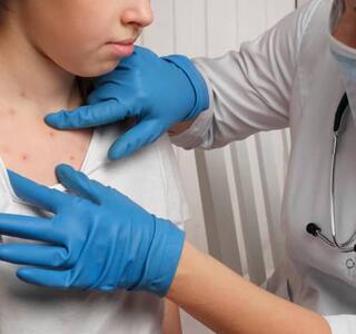 Doctora con guantes azules y mascarilla revisando un sarpullido en el pecho de una mujer, signo de varicela en adultos