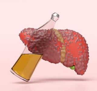 Ilustración de un hígado con textura irregular junto a una botella de cerveza, relacionada con hígado graso y cerveza