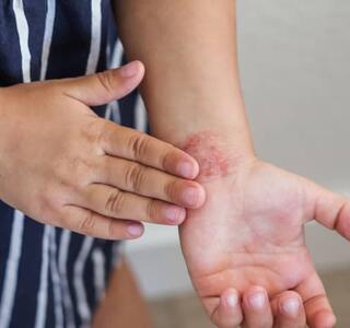 Persona frotándose el antebrazo con la mano por irritación y picor y mostrando un eccema , síntoma típico de dermatitis atópica.