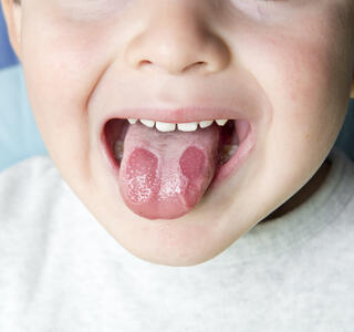 quemaduras en el paladar y lengua