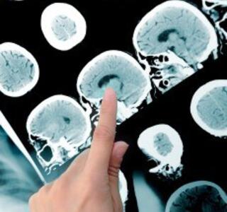 revisión de la esclerosis