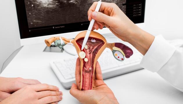 Pólipos en el útero: que son y cómo se tratan | DKV Quiero cuidarme