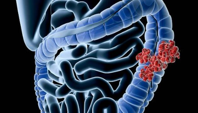 Mitos sobre el cáncer de colon