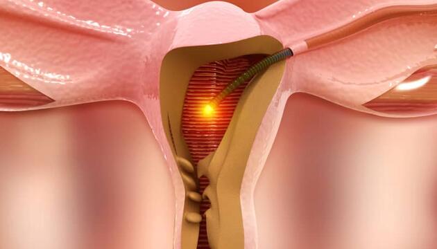 El legrado uterino es una de las técnicas más empleadas para tratar algunas enfermedades del útero