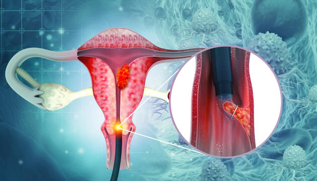 legrado uterino