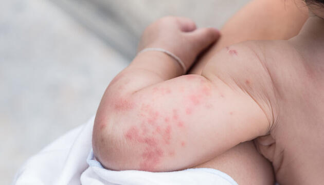 molusco contagioso