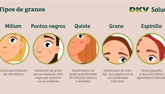 5 tipos de granos en la cara 5 tipos de granos en la cara