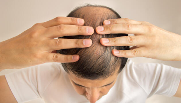 Causas de la caída del cabello y soluciones Causas de la caída del cabello y soluciones