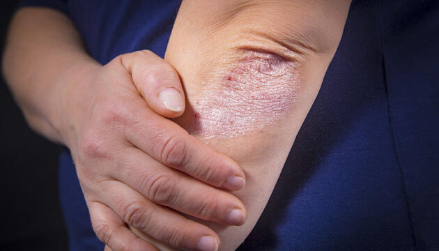 Psoriasis Psoriasis