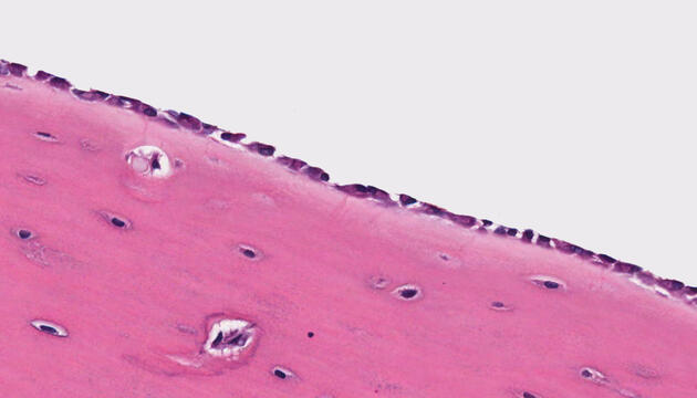 Trasplante de médula ósea trasplante de médula