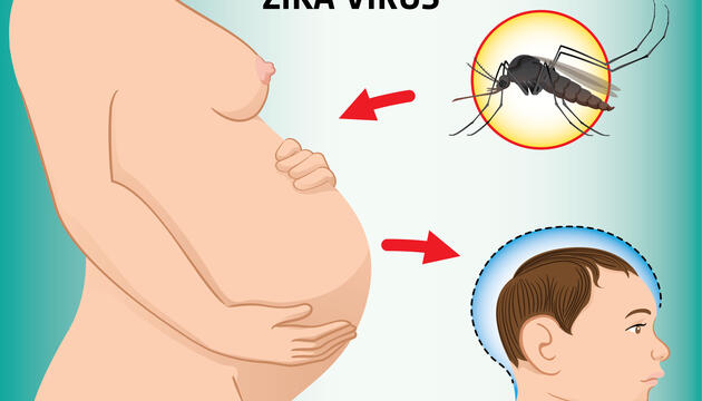 ¿Qué sabemos de la microcefalia? Zika en el embarazo