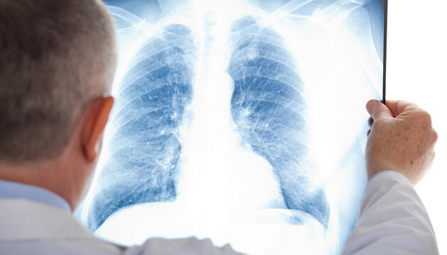 El tabaco, principal causa del cáncer de pulmón