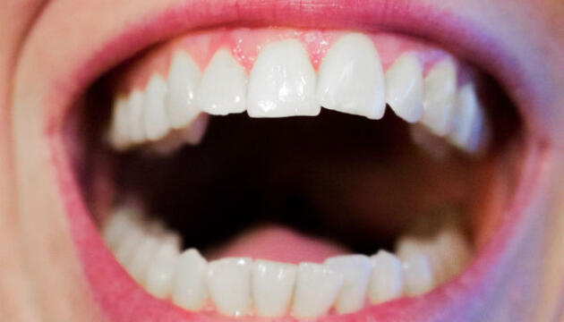 ¿Sellar dientes a los niños? caries en la boca