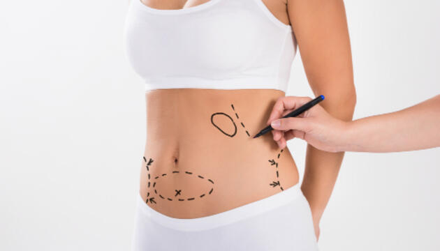 Liposucción: la técnica para remodelar el contorno del cuerpo Liposucción: la técnica para remodelar el contorno del cuerpo