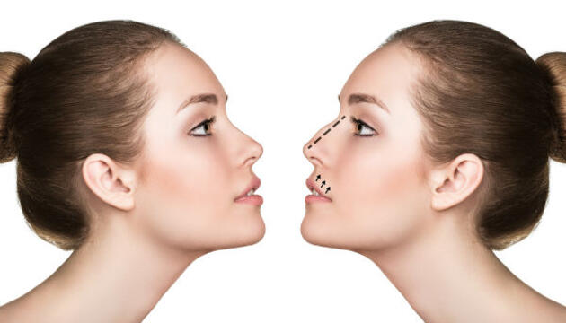 Rinoplastia, la cirugía que cambia el aspecto de tu nariz Rinoplastia, la cirugía que cambia el aspecto de tu nariz