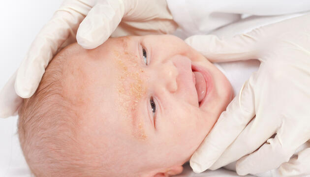 Dermatitis seborreica infantil Dermatitis seborreica infantil