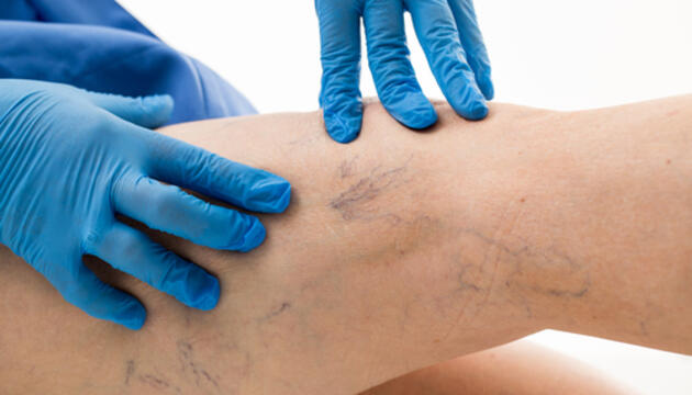 Cómo prevenir las varices Cómo prevenir las varices