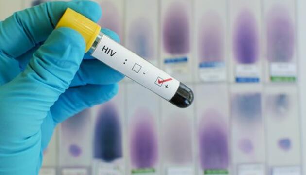 Últimos avances en SIDA muestra de VIH